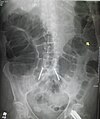 Flat abdominal film of a patient with a large bowel obstruction. Note dilated loops of large bowel.