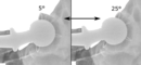 Acetabular anteversion is normally between 5 and 25°.[16] An anteversion below or above this range increases the risk of dislocation.[16] There is an intra-individual variability in this method because the pelvis may be tilted in various degrees in relation to the transverse plane.[16]