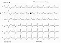 یک تریس ECG