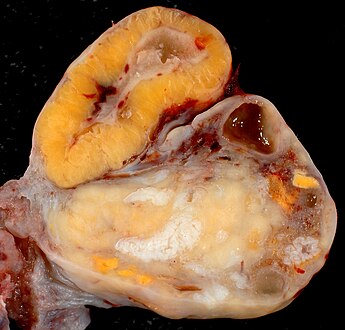 Human ovary with fully developed corpus luteum