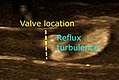 B-flow ultrasonography of venous reflux