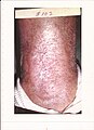 Intractable leg ulcer above the ankle healed after 102 DeMarco formula treatments.
