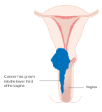 Cervical cancer stage IIIA