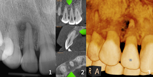 xray and CBCT scans of periapical cemental dysplasia