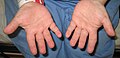 Hands of a person with Langer-Giedion syndrome showing the characteristic short fingers.