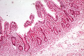 Световая микроскопия слизистой оболочки тонкой кишки: увеличенные ворсинки, инфильтрированные макрофагами