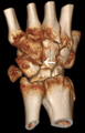 Triquetral fracture indicated by the white arrow.