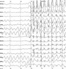 The electroencephalogram recording of a person with childhood absence epilepsy showing a seizure. The waves are black on a white background.