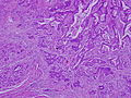 中分化型管状腺癌 (tub2)。