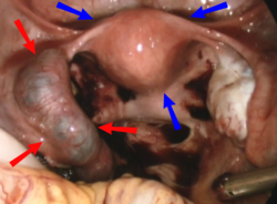 Ectopic pregnancy on laparoscopy.png