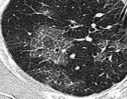 High-resolution computed tomography (HRCT) showing ground-glass attenuation with a geographic or mosaic distribution.[7]