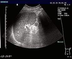 Ultrasonography of an accessory spleen.