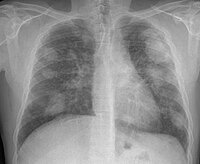 Xray of lungs, lighter patched visible