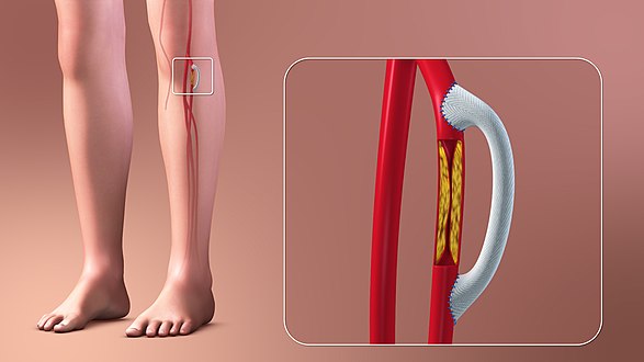 Illustration of vascular bypass.