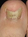 Image 13Onychomycosis (from Fungal infection)