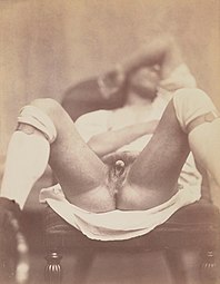 Hermaphrodite, part of a nine-part 1860 medical photo-documentation of an intersex person, believed to be the first of its kind. (8 July)