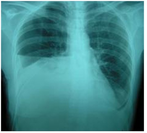 Right-sided pleural effusions caused by urinothorax