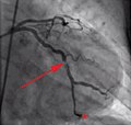 Coronary angiography of a patient with acute myocardial infarction presenting with ST elevation and undergoing primary percutaneous coronary intervention; arrow points at partial occlusion of left circumflex coronary artery; star indicates tip of the guide wire that has been inserted in the artery through the occlusion.