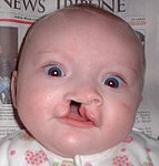 Six-month-old girl before going into surgery to have her unilateral complete cleft lip repaired