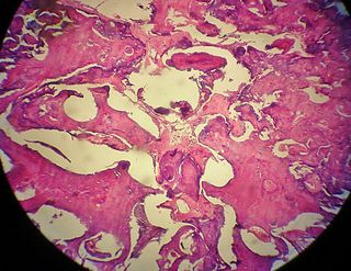 Odontoma. Microscopia com coloração em HE. Observa-se presença de tecido mineralizado.