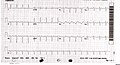 ECG showing sinus tachycardia and non-specific ST and T wave changes from a person with confirmed takotsubo cardiomyopathy