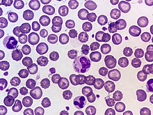 Canine distemper virus cytoplasmic inclusion body (blood smear, Wright's stain)