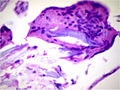 Micrograph showing a foreign body engulfed by a giant cell. H&E stain.