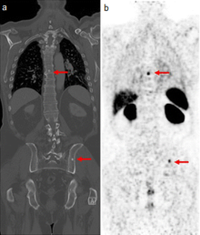 Medical images of a man's torso. Arrows indicate tumor metastases, visible as dots in the man's spine and pelvis, in both scans.