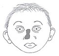 Nasal dysplasia