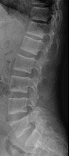 X-ray of a subtle "rugger jersey spine" due to sclerotic bands adjacent to the vertebral endplates.[18]