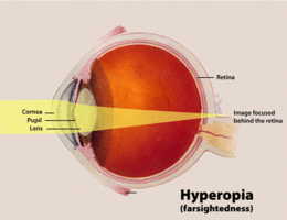 Description de l'image Hyperopia.gif.