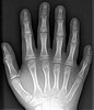 X-ray of hand of patient with polydactyly