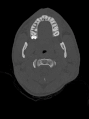 CT تصوير الدماغ