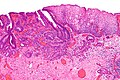 Micrograph showing histopathological appearance of an esophageal adenocarcinoma (dark blue – upper-left of image) and normal squamous epithelium (upper-right of image) at H&E staining