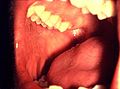 BUCCAL MUCOSA: (Figures 5 and 6) Retract the buccal mucosa. Examine first the right then the left buccal mucosa extending from the labial commissure and back to the anterior tonsillar pillar. Note any change in pigmentation, color, texture, mobility, and other abnormalities of the mucosa, making sure that the commissures are examined carefully and are not covered by the retractors during the retraction of the cheek.