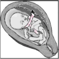 Nuchal cord - free sliding[1]