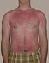 A sunburn is a typical first degree burn.