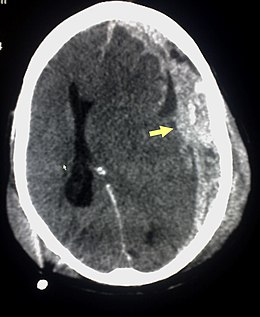 Description de l'image Trauma subdural arrow.jpg.