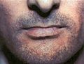 Lichen planus of lower labial mucosa.