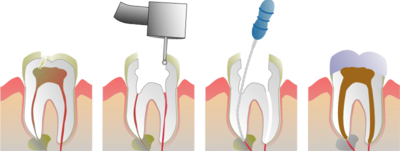 Root Canal Illustration, Molar