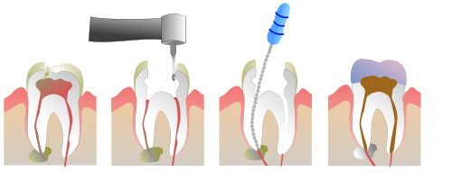 Root canal