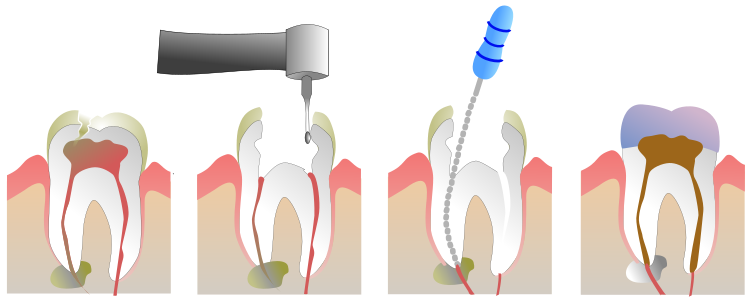 Root canal treatment, by Jeremy Kemp (vectorised by jellocube27)