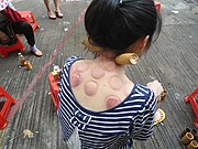 A woman receiving fire cupping in China