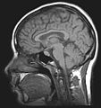An MRI of a human brain.