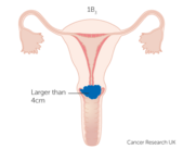 Stage IB3 cervical cancer