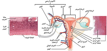 A diagram showing the female reproductive tract with histological images of the uterine wall and normal endometrium