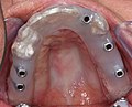 Implantat-Bohrschablone intraoral bei Implantation (Aufsicht)