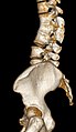 Congenital block vertebra of the lumbar spine. CT volume rendering.