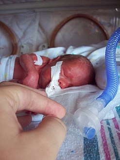 طفل مبتسر على جهاز التنفس الاصطناعي في وحدة عناية مركزة لحديثي الولادة