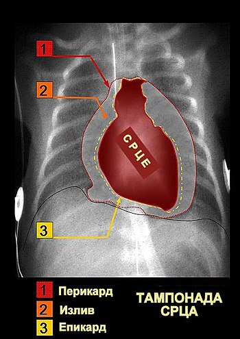Тампонада срца изазвана изливом течности у перикардној шупљини